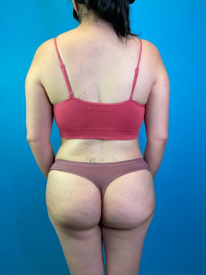 Patient #10365 Brazilian Butt Lift Before and After Photos Beverly Hills - Plastic  Surgery Gallery Greater Los Angeles - Dr. Michael Omidi